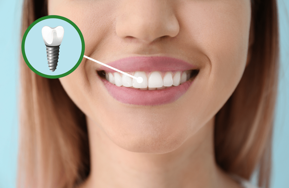 dental implants in Saskatoon