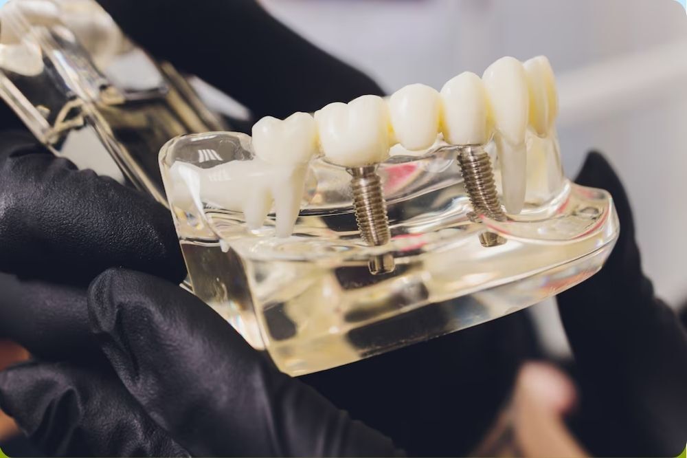 Dental Implants vs. Bridges